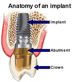 illustration of the anatomy of an implant