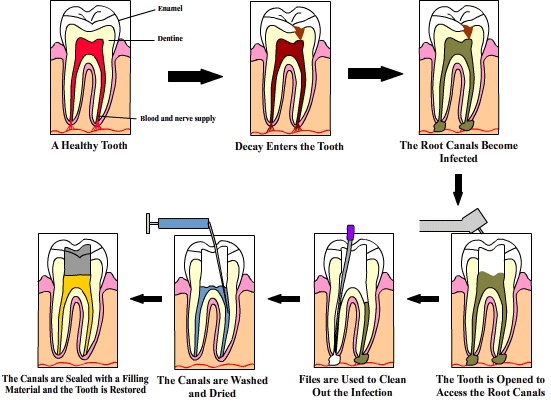 illustration of the process of a root canal 