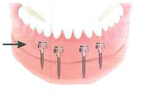 implant retained dentures