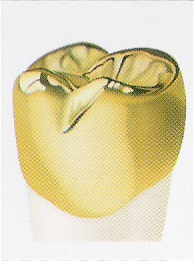 photo of a gold dental crown