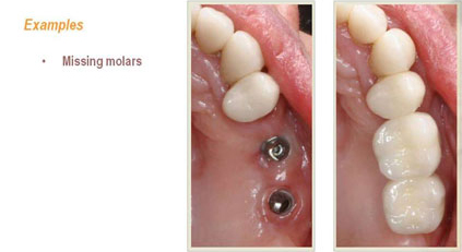 photo of a dental gap with and without crowns