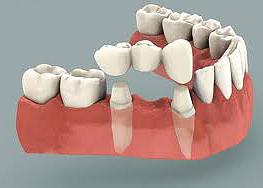 illustration of dental bridge