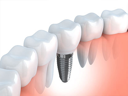 illustration of dental implant