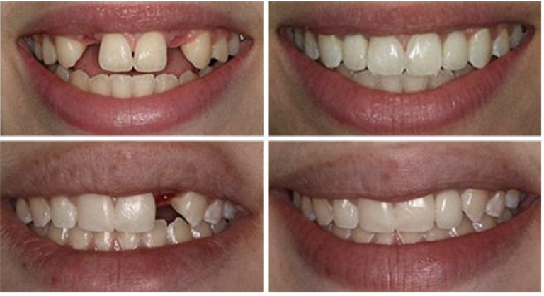 dental results before and after