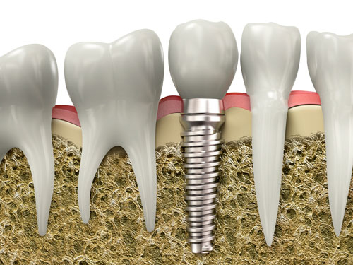 illustration of dental implants