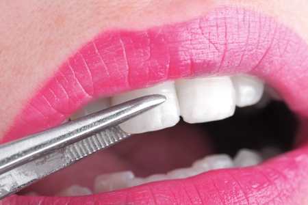 woman having veneer out on tooth